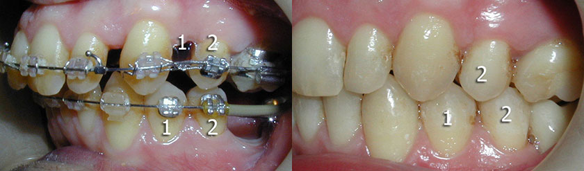 2 Premolar Extraction and Overjet Reduction